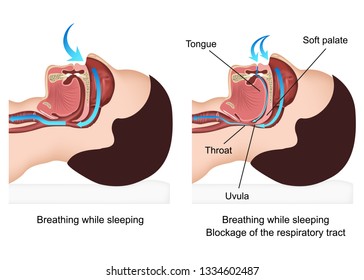 Snoring medical vector illustration with description on white background