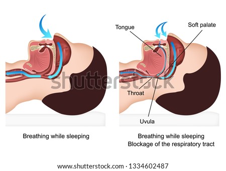 Snoring medical vector illustration with description on white background