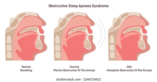 Snoring and OSA. Sleep apnea, snoring syndrome anatony. Partial or complete obstruction of airway. Flat vector illustration