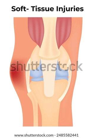 Soft TIssue Injuries Science Design Vector Illusttation  Diagram