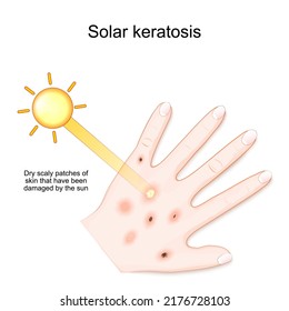 Queratosis solar. Parches de piel seca y escamosa que han sido dañados por el sol. La palma del ser humano con erupción después del sol. ilustración vectorial