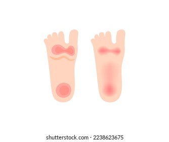 the sole of the foot feels hot and burns. the soles of the feet turn red. disease symptoms Peripheral neuropathy and polyneuropathy. health problems. illustration concept design. vector elements