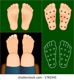 Soles of the feet with and without points foracupuncture, zone therapy etc., and feet seen from above.