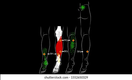 Soleus muscle. Trigger points and reflected leg pain. Myofascial release.