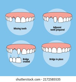 Solution to tooth loss. Fix teeth. Bridge placement process. Oral care