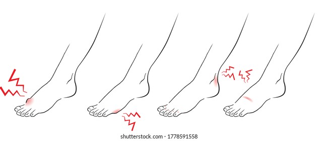 some feet troubles like hallux valgus