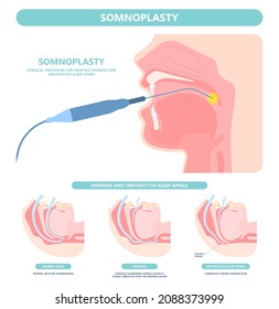 Somnoplastisches chirurgisches Verfahren zur Behandlung von Schnarchen und Obstruktion von Schlafapnoe