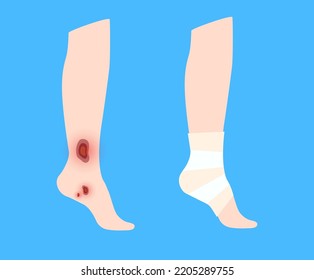 Sore, Cut Or Ulcer On Human Leg. Elastic Bandage, Wrap Medical Gauze Over Foot. Healthcare Concept. First Help With Injured Ankle In A Clinic Or Hospital. Patient With Trauma Flat Vector Illustration