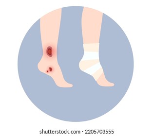 Sore, cut or ulcer on human leg. Elastic bandage, wrap medical gauze over foot. Healthcare concept. First help with injured ankle in a clinic or hospital. Patient with trauma flat vector illustration svg