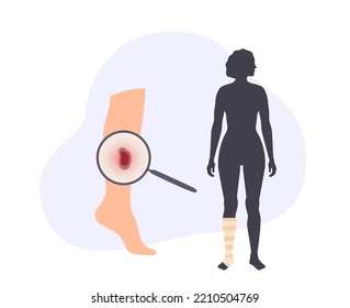 Sore, Cut Or Ulcer On Human Leg. Elastic Bandage, Wrap Medical Gauze Over Foot. Healthcare Concept. First Help With Injured Ankle In A Clinic Or Hospital. Patient With Trauma Flat Vector Illustration