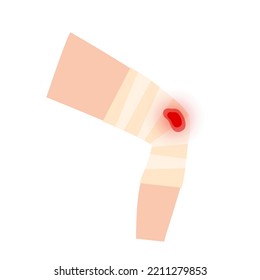 Sore, Cut Or Ulcer On Human Leg. Elastic Bandage, Wrap Medical Gauze Over Knee. Healthcare Concept. First Help With Injured Limb In A Clinic Or Hospital. Patient With Trauma Flat Vector Illustration