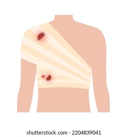 Sore, Cut Or Ulcer On Shoulder. Elastic Bandage, Medical Gauze Wrapping Over A Human Body. Broken Or Injured Bones. Healthcare Concept. First Help In A Clinic. Patient With Trauma Vector Illustration.