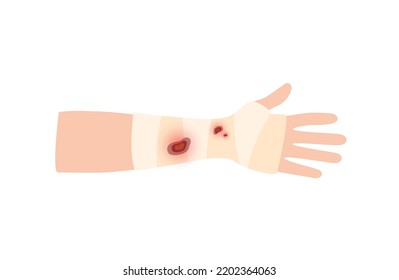 Sore, cut or ulker on human arm. Elastic bandage, wrap medical gauze over forearm. Healthcare concept. First help with injured hand in clinic or hospital. Patient with trauma flat vector illustration