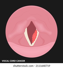 Sore Loss Cough Virus Viral Acute Swell Sound Folds Treat Cysts Palsy Nerve Tumor Botox Throat Hoarse Larynx Airway Polyps Cancer Injury Speech Damage Ulcers Box Chronic Nodules Surgery Reflux Upper