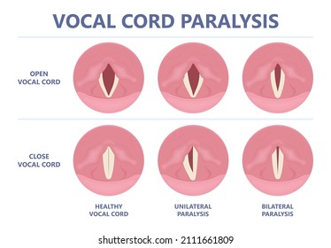 Sore loss cough virus viral acute swell sound folds treat cysts Palsy nerve Tumor botox throat hoarse larynx airway polyps Cancer injury speech damage Ulcers box chronic nodules surgery reflux upper