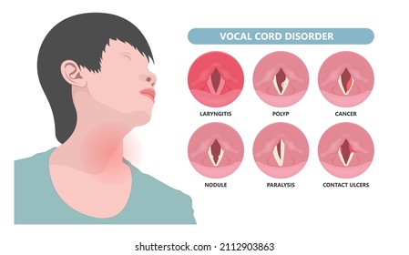 Sore loss cough virus viral acute swell sound folds treat cysts Palsy nerve Tumor botox throat hoarse larynx airway polyps Cancer injury speech damage Ulcers box chronic nodules surgery reflux upper