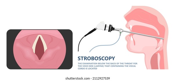 Sore loss cough virus viral acute swell sound folds treat cysts Palsy nerve Tumor botox throat hoarse larynx airway polyps Cancer injury speech damage Ulcers box chronic nodules surgery reflux upper