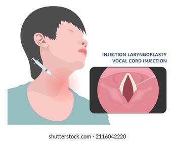 Sore loss cough virus viral acute swell sound folds treat cysts Palsy nerve Tumor botox throat hoarse larynx airway polyps Cancer injury speech damage Ulcers box chronic nodules surgery reflux upper