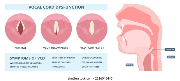 Sore loss cough virus viral acute swell sound folds treat cysts Palsy nerve Tumor botox throat hoarse larynx airway polyps Cancer injury speech damage Ulcers box chronic nodules surgery reflux upper