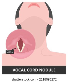 Sore loss cough virus viral acute swell sound folds treat cysts Palsy nerve Tumor botox throat hoarse larynx airway polyps Cancer injury speech damage Ulcers box chronic nodules surgery reflux upper