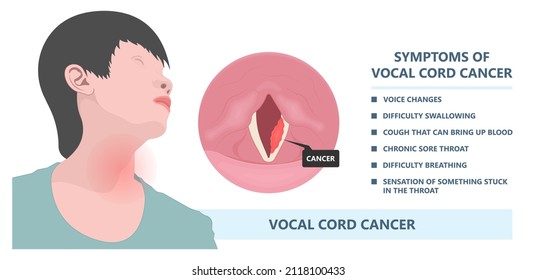 Sore loss cough virus viral acute swell sound folds treat cysts Palsy nerve Tumor botox throat hoarse larynx airway polyps Cancer injury speech damage Ulcers box chronic nodules surgery reflux upper