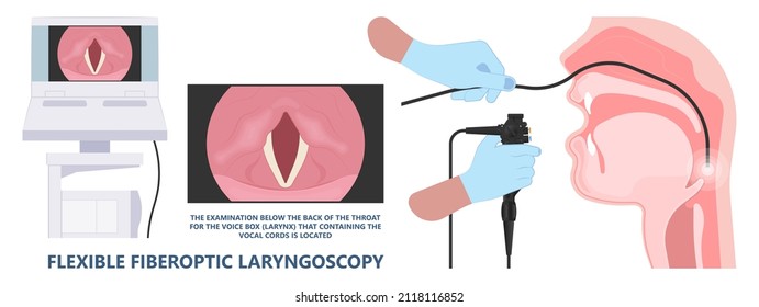 Sore loss cough virus viral acute swell sound folds treat cysts Palsy nerve Tumor botox throat hoarse larynx airway polyps Cancer injury speech damage Ulcers box chronic nodules surgery reflux upper