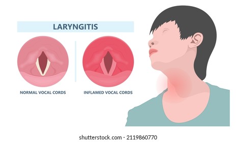 Sore loss cough virus viral acute swell sound folds treat cysts Palsy nerve Tumor botox throat hoarse larynx airway polyps Cancer injury speech damage Ulcers box chronic nodules surgery reflux upper