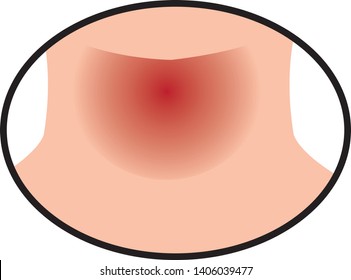 Sore throat because of flu infection. vector illustration on a white background