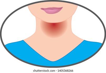 Sore throat because of flu virus influenza insperatory infection vector illustration on a white background