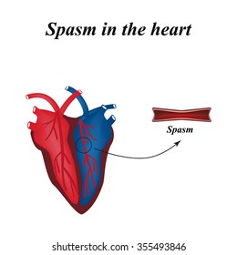 Spasm of the arteries of the heart. Infographics. Vector illustration.