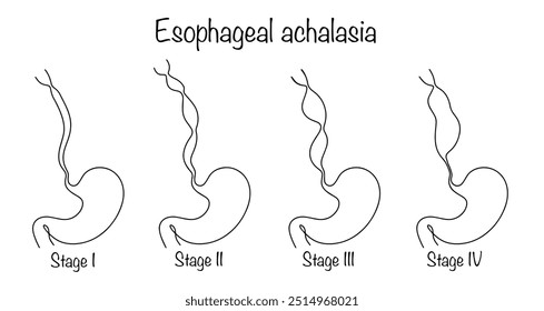 Espasmo do esôfago que leva à interrupção da passagem de alimentos do esôfago para o estômago. Estágios de progressão da doença desenhados à mão. Vetor isolado no fundo branco.