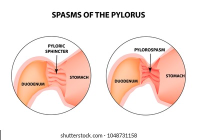 spasms of the pylorus. Pylorospasm. Spastic and atonic. Pyloric sphincter of the stomach. Infographics. Vector image on isolated background