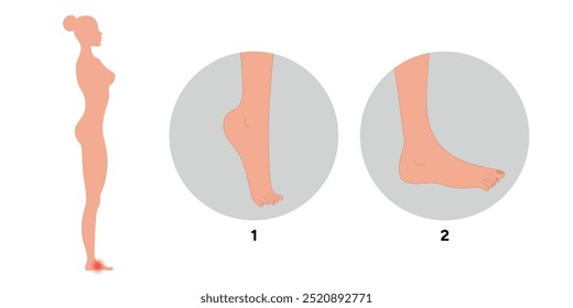 Special exercise for food deformation problem. Orthopedist Therapeutic and strengthening foot up and down