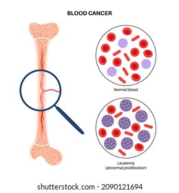 Specimen With Leukemia Disease. Bone Marrow Anatomy. Blood Cancer Concept. Human Circulatory System And Abnormal Amount Of Cells In Blood. Microbiology Test In Laboratory Flat Vector Illustration.