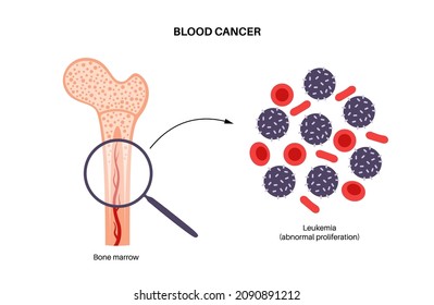 Specimen with leukemia disease. Bone marrow anatomy. Blood cancer concept. Human circulatory system and abnormal amount of cells in blood. Microbiology test in laboratory flat vector illustration.