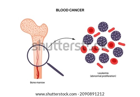Specimen with leukemia disease. Bone marrow anatomy. Blood cancer concept. Human circulatory system and abnormal amount of cells in blood. Microbiology test in laboratory flat vector illustration.