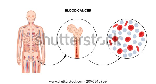 Specimen Leukemia Disease Bone Marrow Anatomy Stock Vector Royalty