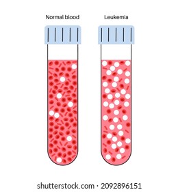 Specimen with leukemia disease and normal blood. Blood cancer concept. Human blood cells structure. Thrombocytes and leukocytes under microscope vector illustration. Microbiology test in laboratory