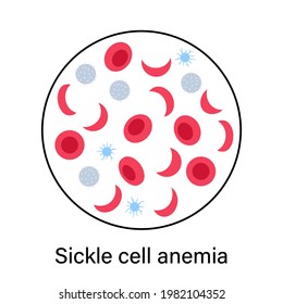 Especie con concepto de anemia por células falciformes. Estructura de células sanguíneas humanas bajo microscopio. Prueba de microbiología en laboratorio. Ilustración de vectores planos médicos aislados para clínicas, hospitales o educación