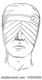 Spectacles or eye bandage crosses two globes, vintage engraved illustration. Usual Medicine Dictionary - Paul Labarthe - 1885.