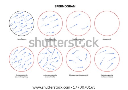 Sperm morphology and ivf research concept. Normal, abnormal and defective human egg. Spermatozoon flat vector illustration. Human sexual reproductive system. Diagram for clinic and education