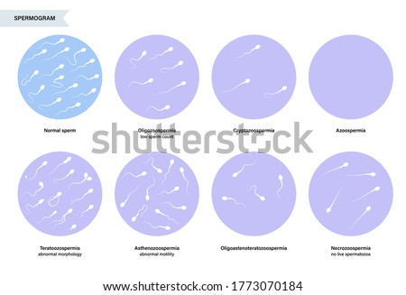 Sperm morphology and ivf research concept. Normal, abnormal and defective human egg. Spermatozoon flat vector illustration. Human sexual reproductive system. Diagram for clinic and education