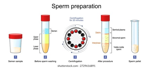 Preparación de espermatozoides. Fecundación in vitro. Muestra de semen en contenedor. Centrifugación de espermatozoides, antes y después del procedimiento de lavado. Gránulos de espermatozoides en el tubo de ensayo. Fertilidad masculina. Vector Diagrama médico