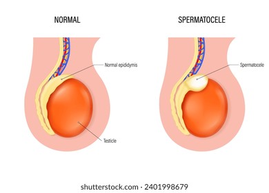 Vector espermatocele. Comparación de epidídimo normal y espermatocele. Enfermedad testicular. Sistema reproductivo masculino.