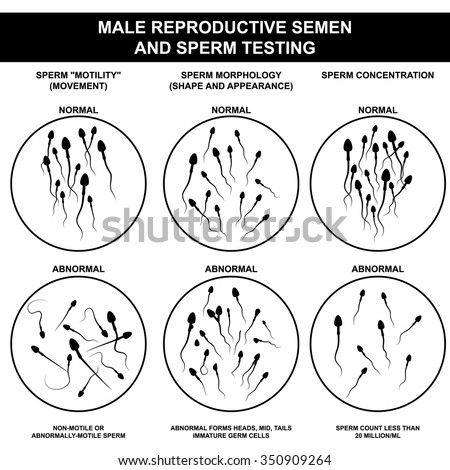 Spermogram and semen parameters, oligozoospermia, asthenozoospermia, teratozoospermia, normal and abnormal sperm