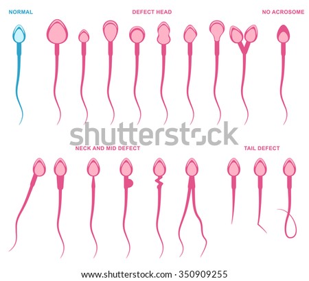 Spermogram and semen parameters, teratozoospermia, normal and abnormal sperm
