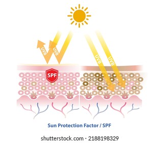 SPF blocks UVB radiation penetrate into the skin layer vector on white background. Comparison of skin with sunscreen and no sunscreen. Skin care and beauty concept illustration.