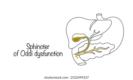 Disfunción del esfínter de Oddi. Enfermedad caracterizada por la obstrucción parcial de los conductos biliares y del jugo pancreático en el esfínter de Oddi. Vector médico para diferentes usos.