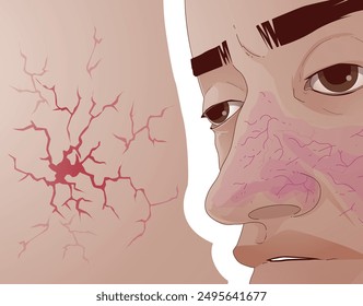 Spider Angioma. Vascular spider. Skin problems. Healthcare illustration. Vector illustration.