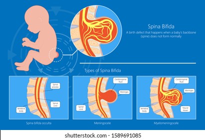 Spina Bifida Birth Defects Infant Disease Neural Tube Pregnant